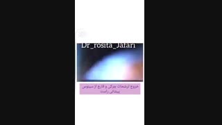 پتوز= افتادگی پلک