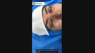 جراحی پلک چگونه انجام می شود