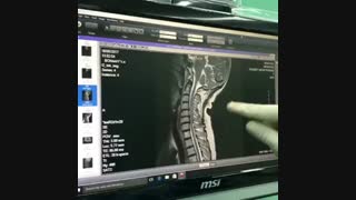 نمونه جراحی فقرات گردنی (دکتر القاسی)متخصص جراحی ستون فقرات