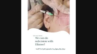 درمان جای جوش همراه با سابسیژن و ژل جراحی زیبایی پلک
