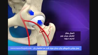 درمان دکمپرشن در سیاه شدن سر استخوان ران