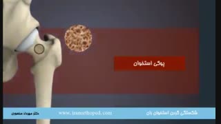 شکستگی گردن فمور در ناحیه لگن