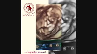 فیلم سونوگرافی nt