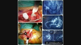عملیه استبدال مفصل الحوض بالکامل