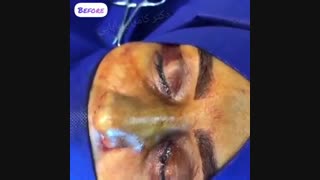 نمونه جراحی زیبایی بینی دکتر کامران بابایی لیپوساکشن