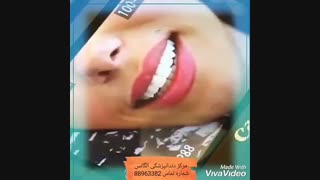 فرق لمینیت دندان با کامپوزیت دندان | تفاوت روکش دندان و ونیر کامپوزیت | مزایای روکش دندان | ماندگاری روکش دندان