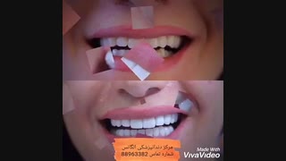 لبخند هالیوودی | پرسلن کامپوزیت | روش پرسلن گذاری | مراحل پرسلن گذاری | روش های مرتب کردن دندان