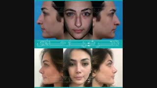 نمونه کار جراحی بینی