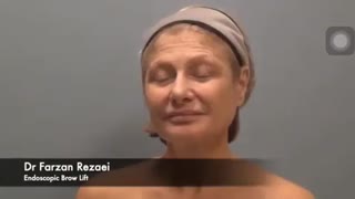 لیفت دائمی  ابرو و پیشانی با آندوسکوپ