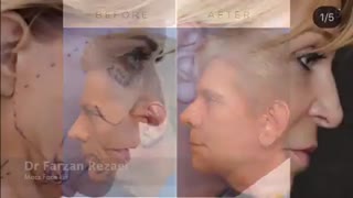 همه چیز در مورد لیفت صورت