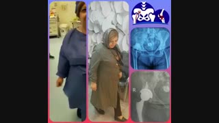 معاینه بیمار قبل و بعد از تعویض مفصل لگن سمت راست
