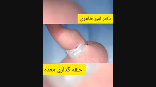 حلقه گذاری معده