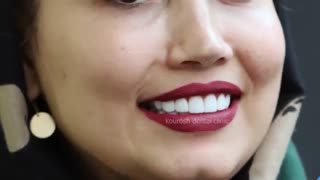 فیلم دندان کامپوزیت | قبل و بعد کامپوزیت دندان | کامپوزیت دندان جلو