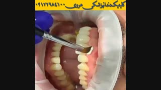 لامینت ونیر در دندانپزشکی | تاثیر لمینت سرامیکی در زیبایی دندان ها