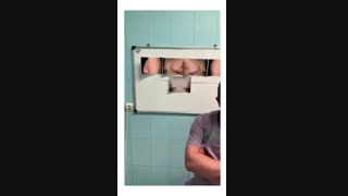 جراحی ترمیم ژنیکوماستی در بیمار 20ساله