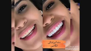 بهترین روکش دندان | دندانپزشکی زیبایی خیلی خوب مرکز تهران | دندانپزشکی ترمیمی مرکز تهران | قیمت لمینیت دندان