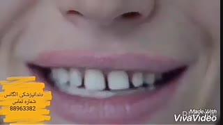 پرسلن کامپوزیت چیست | مراحل چسباندان لمینیت دندان | قیمت عصب کشی دندان سال 98 | انجام عصب کشی بدون درد