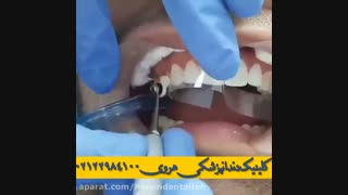 ترمیم کامپوزیتی دندان چیست؟