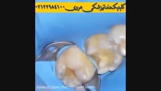 پر کردن و ترمیم دندان آسیاب با مواد همرنگ