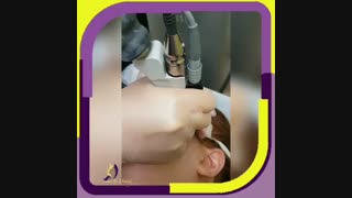 لیزر الکساندرایت صورت برای از بین بردن کک و مک