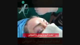 فیلم جراحی لیفت ابرو توسط دکتر علی منافی