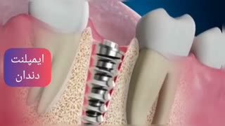 ایمپلنت دندان جلو