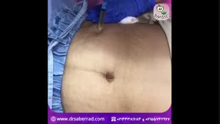 مزوتراپی شکم دندانپزشک زیبایی