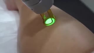 طریقه ی انجام لیزر موهای زائد