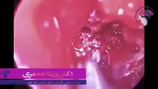 فیلم تومورها و توده های مربوط به بینی و سینوس ها