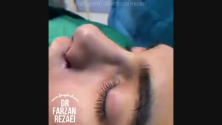 جراحی بینی مردانه