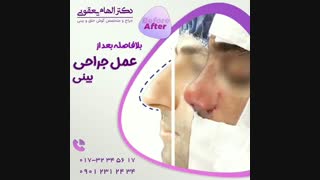 بلافاصله بعد از عمل بینی