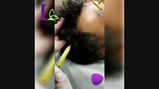 فیلم پی آر پی مو جراحی لثه