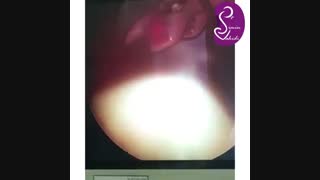 فیلم عمل کلیه - برداشتن فشار بعد از سال ها