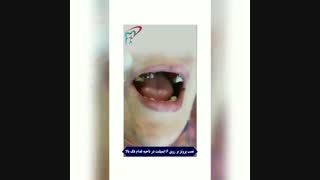 نصب پروتز بر روی ۶ ایمپلنت در ناحیه قدام فک بالا