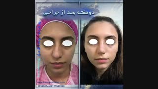 نتیجه جراحی زیبایی بینی دو هفته پس از عمل