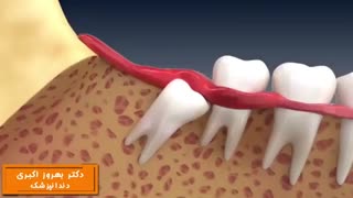 انیمیشن کشیدن دندان عقل