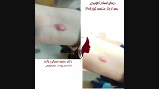 فیلم واقعی درمان اسکار کلوییدی