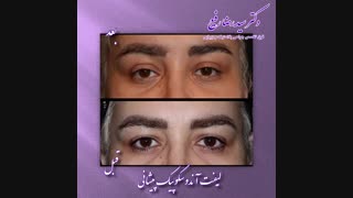 لیفت آندوسکوپیک پیشانی | دکتر سید رضا رفیع | فوق تخصص جراحی پلاستیک پروتز سینه