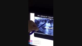 کاشت 6 واحد ایمپلنت دندان بصورت هم زمان توسط دکتر شهرام اسعدی کشیدن دندان