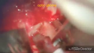 تومور عصب بینایی