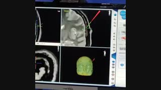 کلافه عروقی شریانی و وریدی