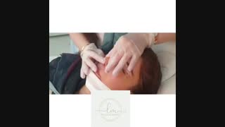لیفت شقیقه جراحی بینی و بلفارو پلاستی پلک بالا