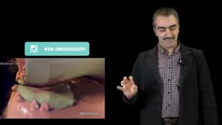 طول عمرتعویض مفصل زانو