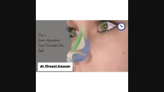 جراحی بینی و نحوه انجام آن