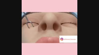 جراحی رینوپلاستی