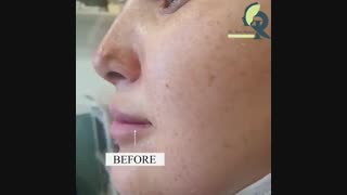 نتیجه تزریق ژل لب توسط دکتر ایمان روغنی اصلاح طرح لبخند
