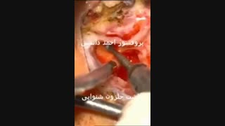 فیلم کاشت حلزون گوش