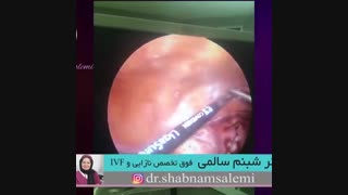 درمان فیبروم رحم با لاپاراسکوپی