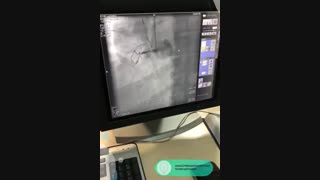 درد قفسه سینه