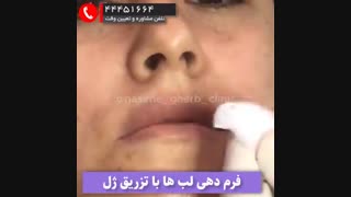 تزریق ژل لب نورامیس